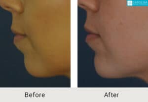 Kulbersh_Before-After-Fillers-for-Chin-Augmentation-LARGE-06-06-2023-(1)-carolina-facial-plastics-charlotte