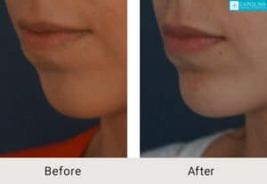Kulbersh_Before-After-Fillers-for-Chin-Augmentation-LARGE-06-06-2023 (2)-carolina-facial-plastics-charlotte