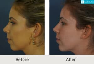 Kulbersh_Before-After-Fillers-for-Chin-Augmentation-LARGE-06-06-2023 (3)-carolina-facial-plastics-charlotte
