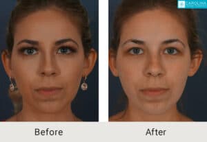 Kulbersh_Before-After-Fillers-for-Chin-Augmentation-LARGE-06-06-2023 (4)-carolina-facial-plastics-charlotte