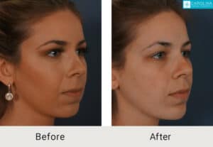Kulbersh_Before-After-Fillers-for-Chin-Augmentation-LARGE-06-06-2023 (5)-carolina-facial-plastics-charlotte