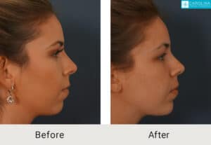 Kulbersh_Before-After-Fillers-for-Chin-Augmentation-LARGE-06-06-2023 (6)-carolina-facial-plastics-charlotte