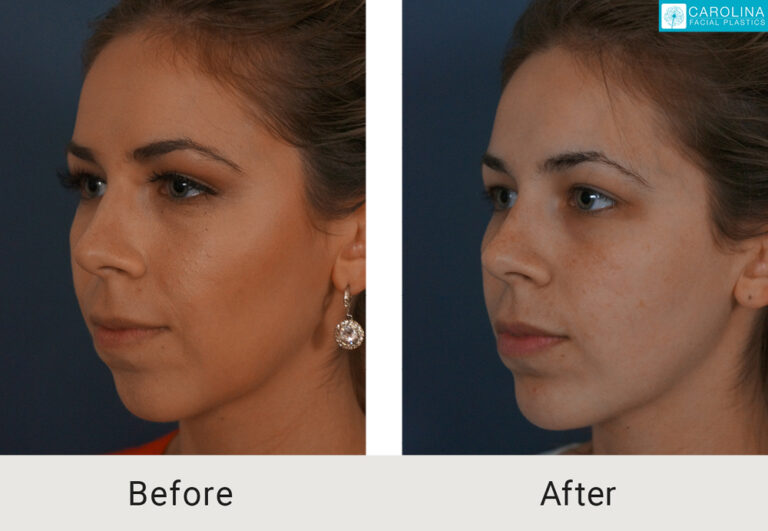 dermal fillers for chin augmentation before and after