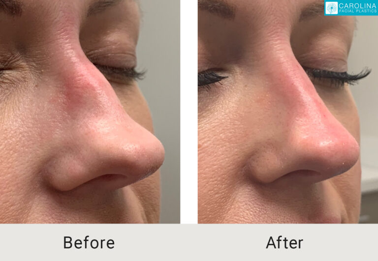 before and after of a non-surgical rhinoplasty procedure