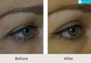 Kulbersh_Before-After-Upper-Blepharoplasty Surgeon Charlotte_LARGE_06-1-2023- (1)