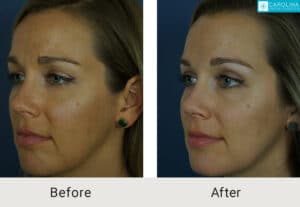 Kulbersh_Before-After-Upper-Blepharoplasty Surgeon Charlotte_LARGE_06-1-2023- (2)