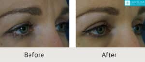 Kulbersh_Before-After-Upper-Blepharoplasty Surgeon Charlotte_LARGE_06-1-2023- (3)