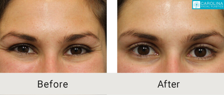 botox results before and after injections