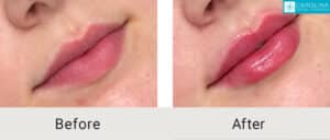 Kulbersh_Before-After__Lip-Filler-to-Plump-Lips-Charlotte-LARGE-06-06-202311
