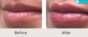 Kulbersh_Before-After__Lip-Filler-to-Plump-Lips-Charlotte-LARGE-06-06-20233