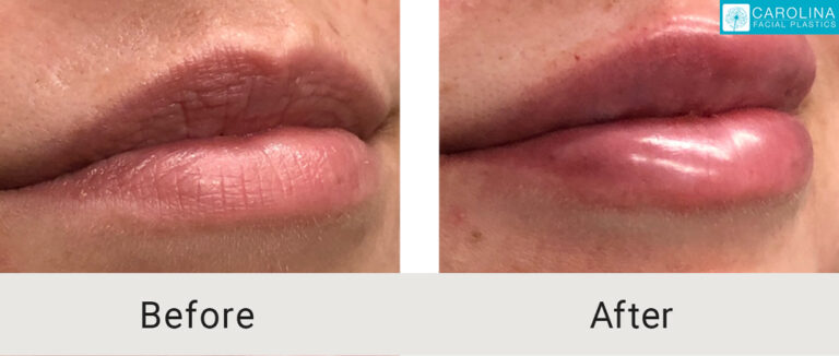lips before and after lip filler injections