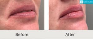 Kulbersh_Before-After__Lip-Filler-to-Plump-Lips-Charlotte-LARGE-06-06-20236