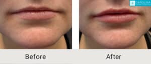 Kulbersh_Before-After__Lip-Filler-to-Plump-Lips-Charlotte-LARGE-06-06-20237