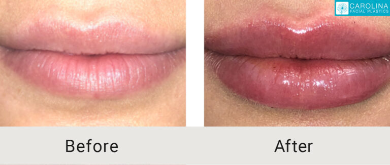 lip augmentation injections to plump lips of a charlotte patient