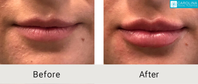 lips before and after lip fillers
