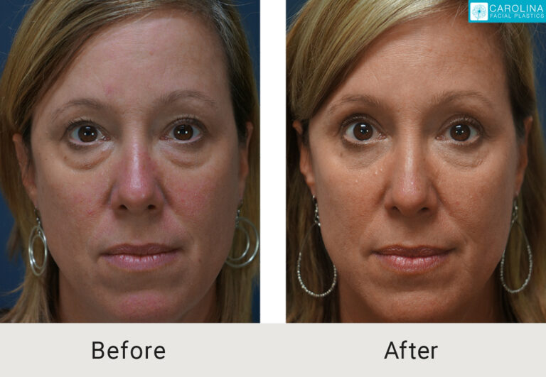 blepharoplasty before and after on a female patient from Charlotte