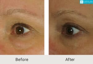 upper-and-lower-blepharoplasty-Kulbersh_Before-After-06-05-2023-(2)