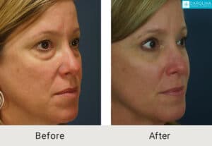upper-and-lower-blepharoplasty-Kulbersh_Before-After-06-05-2023-(3)
