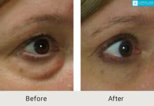 upper-and-lower-blepharoplasty-Kulbersh_Before-After-06-05-2023-(4)