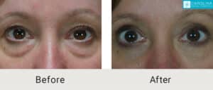 upper-and-lower-blepharoplasty-Kulbersh_Before-After-06-05-2023-(5)