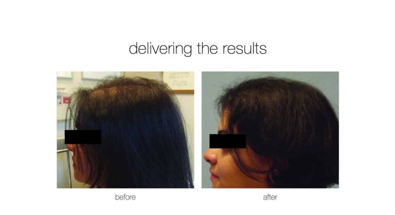 neograft hair transplant to treat hair loss before and after