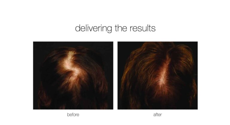 neograft hair transplant to treat female hair thinning and hair loss for a patient from Charlotte NC