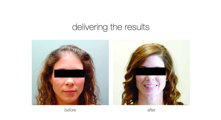 neograft hair transplant results on a female patient to treat female baldness