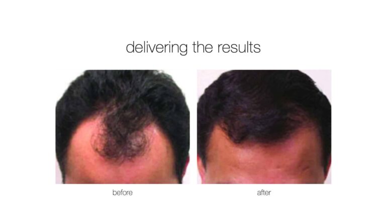 hair transplant for a patient from Charlotte NC to treat hair thinning and male pattern baldness