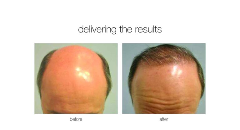 hair transplant to treat male pattern baldness on a patient from North Carolina