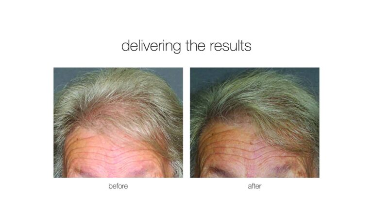 hair restoration with neograft