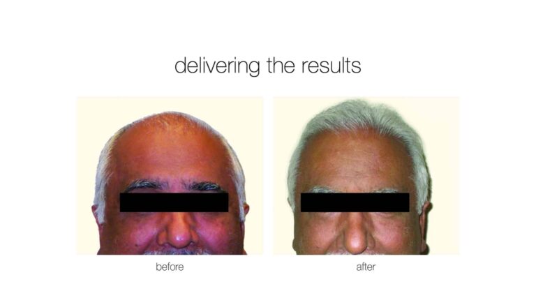 neograft hair transplant for male pattern baldness before and after