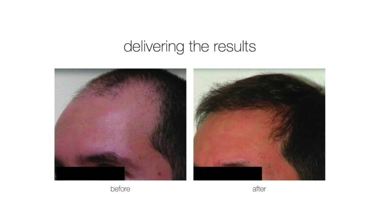 neograft hair transplant before and after
