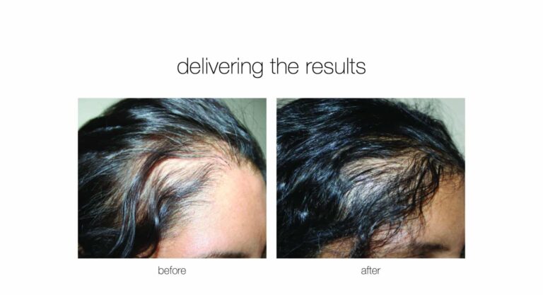 hair transplant before and after on a female patient