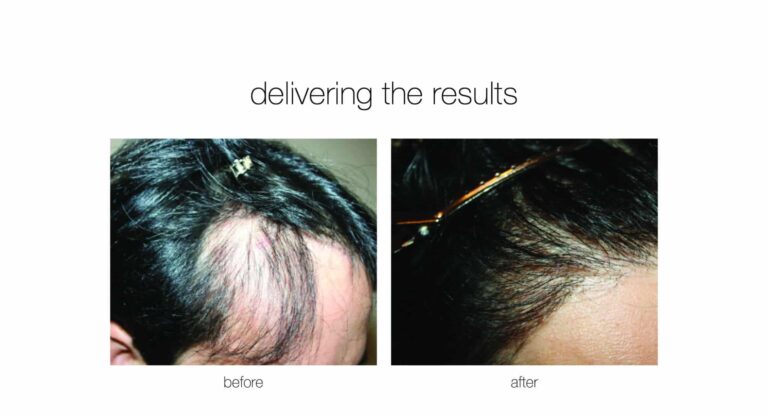 hair transplant surgery results on a patient from Charlotte