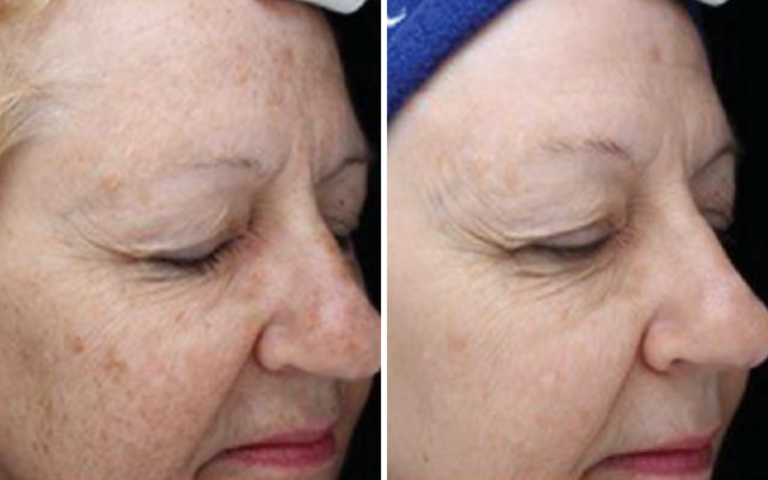 Angular view of female patients face before and after pigmentation treatment with BBL Hero in Charlotte