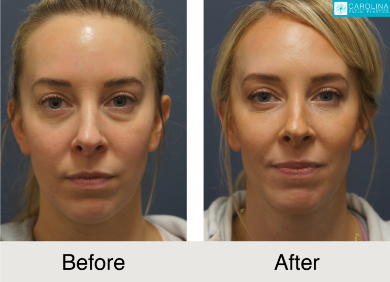 Lower Blepharoplasty Female patient before and after photo showing results in Charlotte
