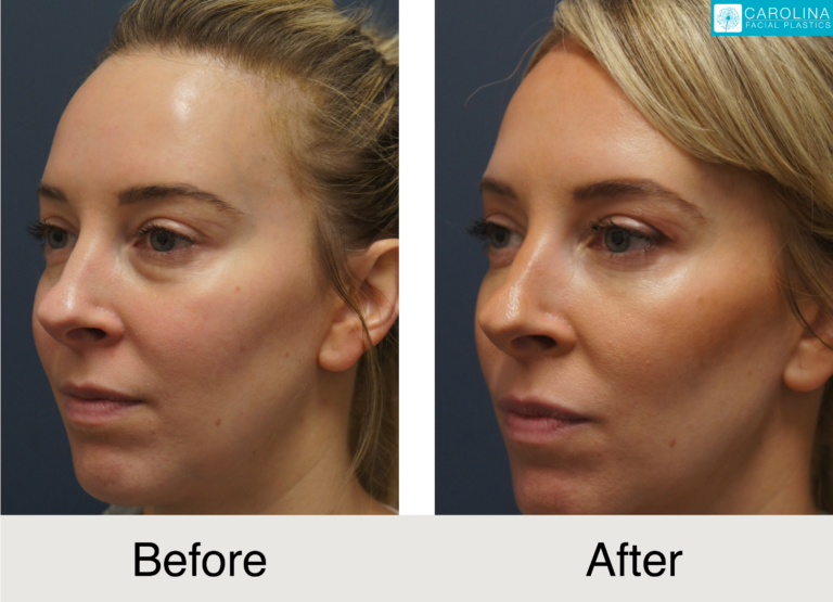 Lower Blepharoplasty Female Patient Before and After photo showing results in Charlotte