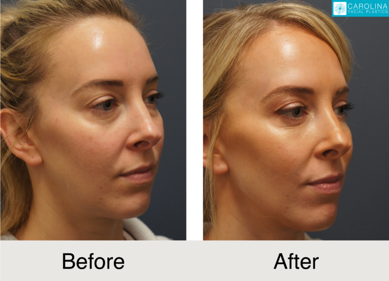 Lower Blepharoplasty Female Patient Before and After photo showing results in Charlotte