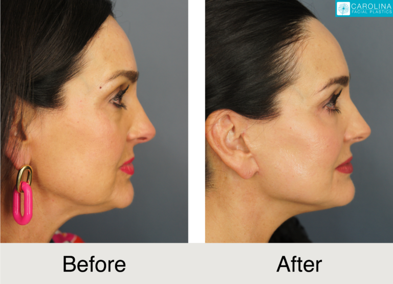 a female patient before and after a buccal fat removal procedure