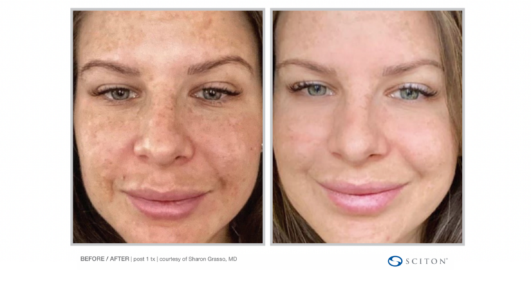 Frontal view of female patient displaying complexion improvement following BBL Hero treatment in Charlotte