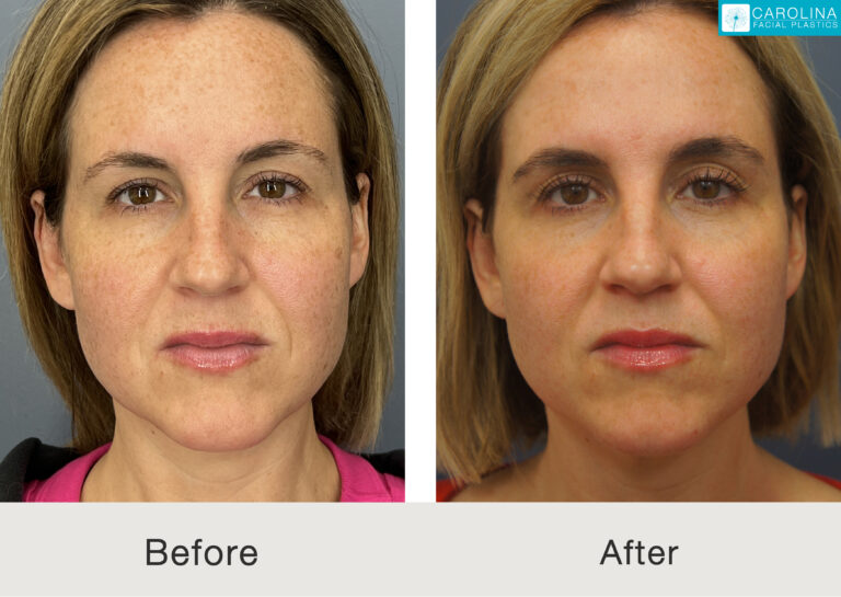 Frontal view of female patient results following BBL Hero treatment in Charlotte
