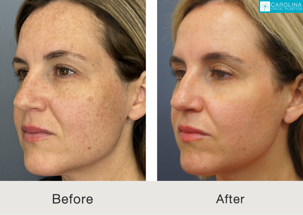 Female patient before and after laser resurfacing on the face to treat pigmentation concerns in Charlotte