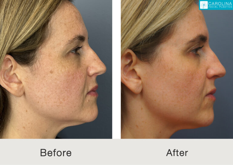 Female patient before and after treatment with BBL Hero in Charlotte