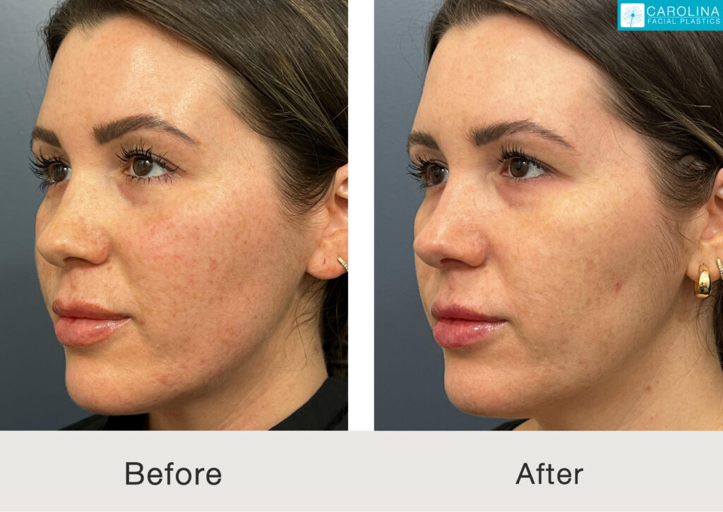 Side-by-side image showcasing laser skin resurfacing results following treatment in Charlotte