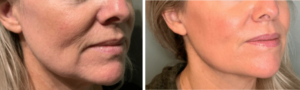 Two close-up images showing the left profile and front-left view of a woman's face. The left image displays signs of facial skin texture irregularities and minor wrinkles. The right image shows the same woman after cosmetic treatment, with smoother and more even skin texture, and fewer visible wrinkles.