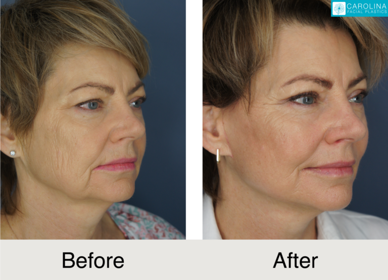 results of a chemical peel procedure on a patient in charlotte