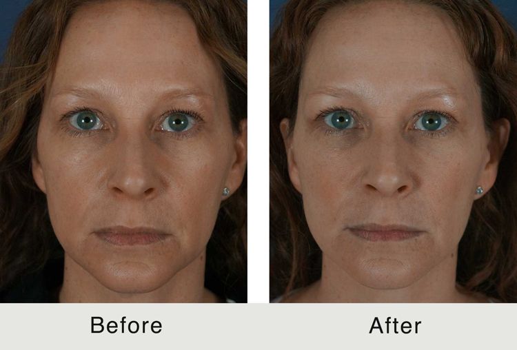Side-by-side comparison of a woman's face before and after some treatment. Both images show her looking directly at the camera with a neutral expression. The "Before" photo is on the left, and the "After" photo is on the right. The woman has blue eyes, fair skin, and light brown hair. Her skin appears smoother in the "After" photo, indicating an improvement in complexion or texture.