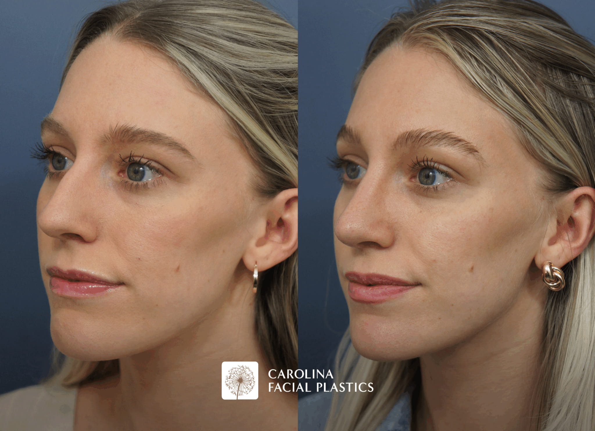 Side view of female patient before and after septorhinoplasty to improve nasal function and form in Charlotte