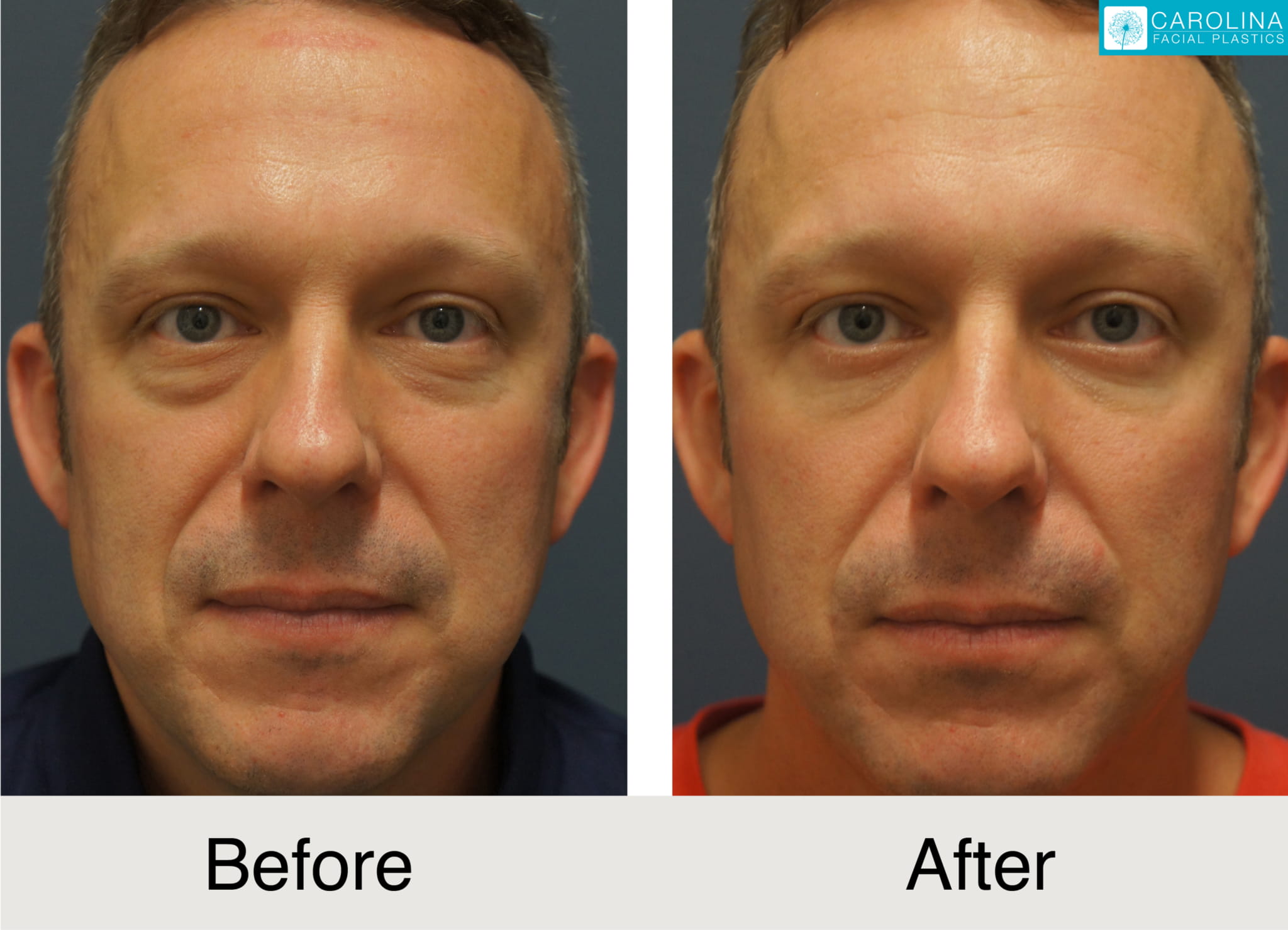 lower blepharoplasty male before and after photos