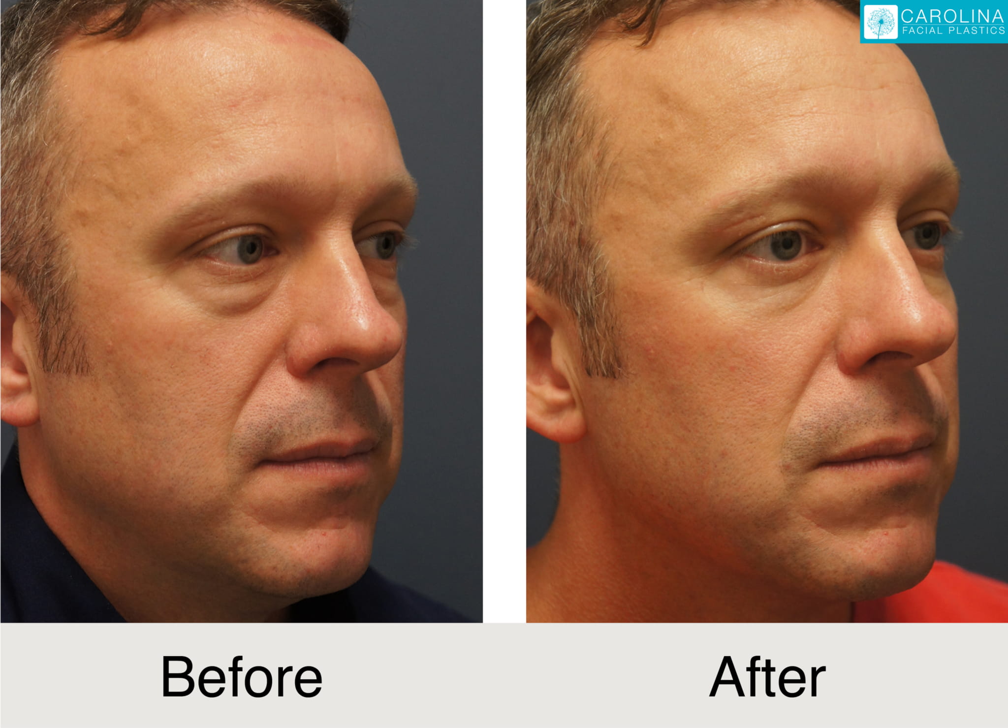 lower blepharoplasty male before and after photos